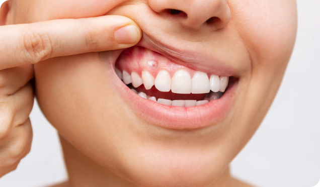 Gum abscess requiring urgent dental attention. In Surrey, we provide emergency dental care solutions.
