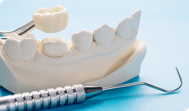 Immediate relief for a lost filling or crown with our emergency dental services in Surrey, BC – restoring your smile with expert care.