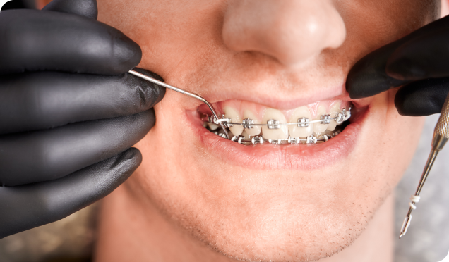 A man with broken metal braces receives emergency orthodontic treatment, ensuring prompt care for a comfortable and effective solution
