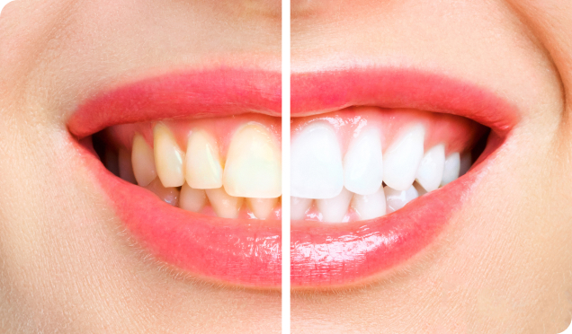 Before And After Teeth Cleaning And Teeth Whitening Treatment Results On A Woman