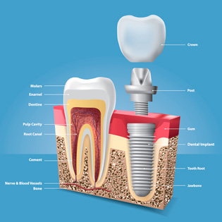 Implant Dentistry Dental Treatment In Surrey Dental Clinic