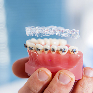 Invisalign And Fixed Braces Dental Treatment At Dental Clinic In Surrey BC
